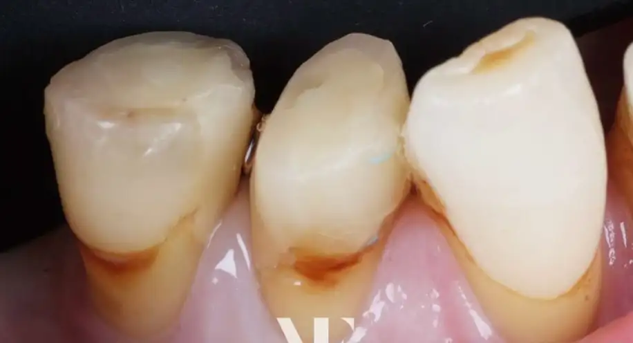 Before Composite Bonding